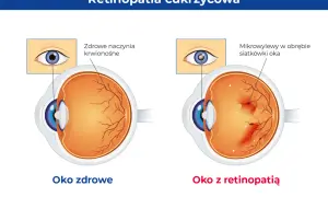 Porównanie oka zdrowego z okiem z retinopatią cukrzycową. W zdrowym oku naczynia krwionośne siatkówki są prawidłowe, w chorym występują mikrowylewy.