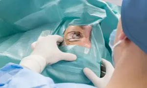Oko pacjenta podczas zabiegu laserowej korekcji wzroku, przygotowywane przez chirurga w rękawiczkach.
