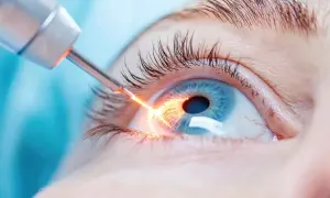 Laserowa irydotomia oka, która może powodować zaburzenia widzenia po zabiegu.