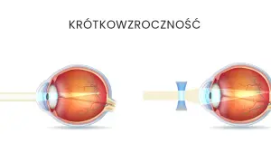 Krótkowzroczność: Jakie soczewki wybrać? Poradnik