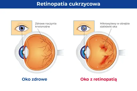 Porównanie oka zdrowego z okiem z retinopatią cukrzycową. W zdrowym oku naczynia krwionośne siatkówki są prawidłowe, w chorym występują mikrowylewy.