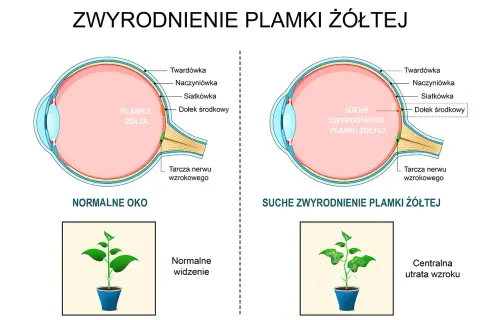 Porównanie zdrowego oka z suchym zwyrodnieniem plamki żółtej, pokazujące utratę ostrości widzenia.
