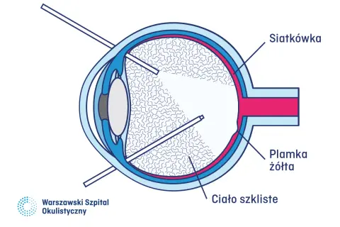 Schemat oka z zaznaczonymi elementami: siatkówka, plamka żółta, ciało szkliste. Wskazuje na nieudaną witrektomię, pokazując narzędzia wewnątrz oka.
