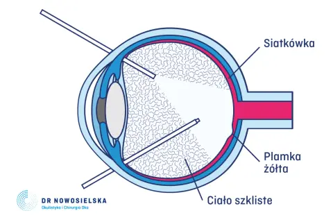 Schemat oka po witrektomii z gazem. Widzenie może być zniekształcone przez bańkę gazu wypełniającą ciało szkliste.