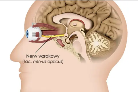 Przekrój głowy ukazujący oko i nerw wzrokowy. Zanik nerwu wzrokowego rokowania może wpływać na widzenie.