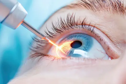 Laserowa irydotomia oka, która może powodować zaburzenia widzenia po zabiegu.
