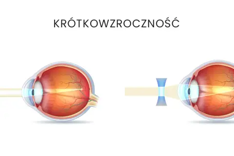 Krótkowzroczność: Jakie soczewki wybrać? Poradnik