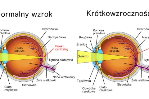 Porównanie budowy oka z normalnym wzrokiem i krótkowzrocznością. Ćwiczenia na poprawę wzroku mogą pomóc w zrozumieniu mechanizmów widzenia.
