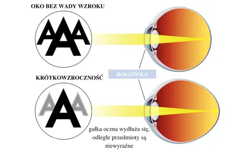 Ilustracja porównująca oko zdrowe i krótkowzroczne, pokazująca ogniskowanie światła.