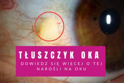 Żółtawy tłuszczyk na oku, widoczny w czerwonym okręgu, to niegroźna narośl. Dowiedz się więcej o tym zjawisku.