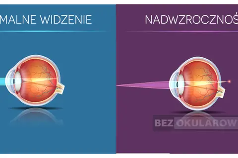 Plusy na recepcie? Zrozum dalekowzroczność i jak ją korygować