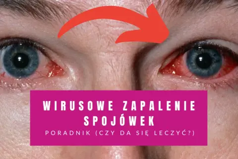 Czerwone, podrażnione oczy z widocznymi naczynkami. Napis informuje o wirusowym zapaleniu spojówek i poradniku leczenia.