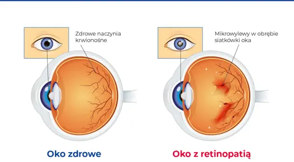 Porównanie oka zdrowego z okiem z retinopatią cukrzycową. W zdrowym oku naczynia krwionośne siatkówki są prawidłowe, w chorym występują mikrowylewy.