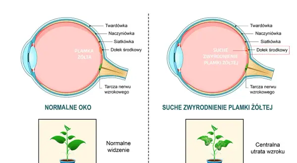 Porównanie zdrowego oka z suchym zwyrodnieniem plamki żółtej, pokazujące utratę ostrości widzenia.