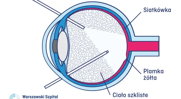 Schemat oka z zaznaczonymi elementami: siatkówka, plamka żółta, ciało szkliste. Wskazuje na nieudaną witrektomię, pokazując narzędzia wewnątrz oka.