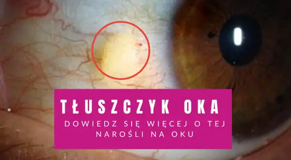 Żółtawy tłuszczyk na oku, widoczny w czerwonym okręgu, to niegroźna narośl. Dowiedz się więcej o tym zjawisku.