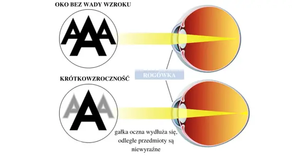 Ilustracja porównuje oko zdrowe z okiem krótkowzrocznym, pokazując różne rodzaje wad wzroku. W krótkowzroczności gałka oczna wydłuża się, powodując niewyraźne widzenie odległych przedmiotów.