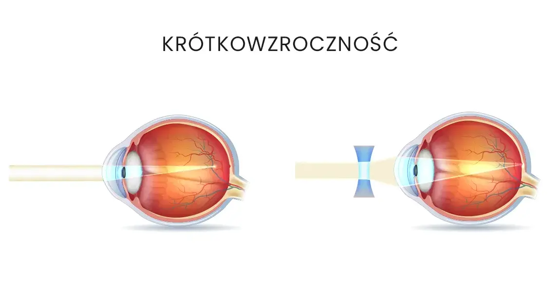 Krótkowzroczność: Jakie soczewki wybrać? Poradnik