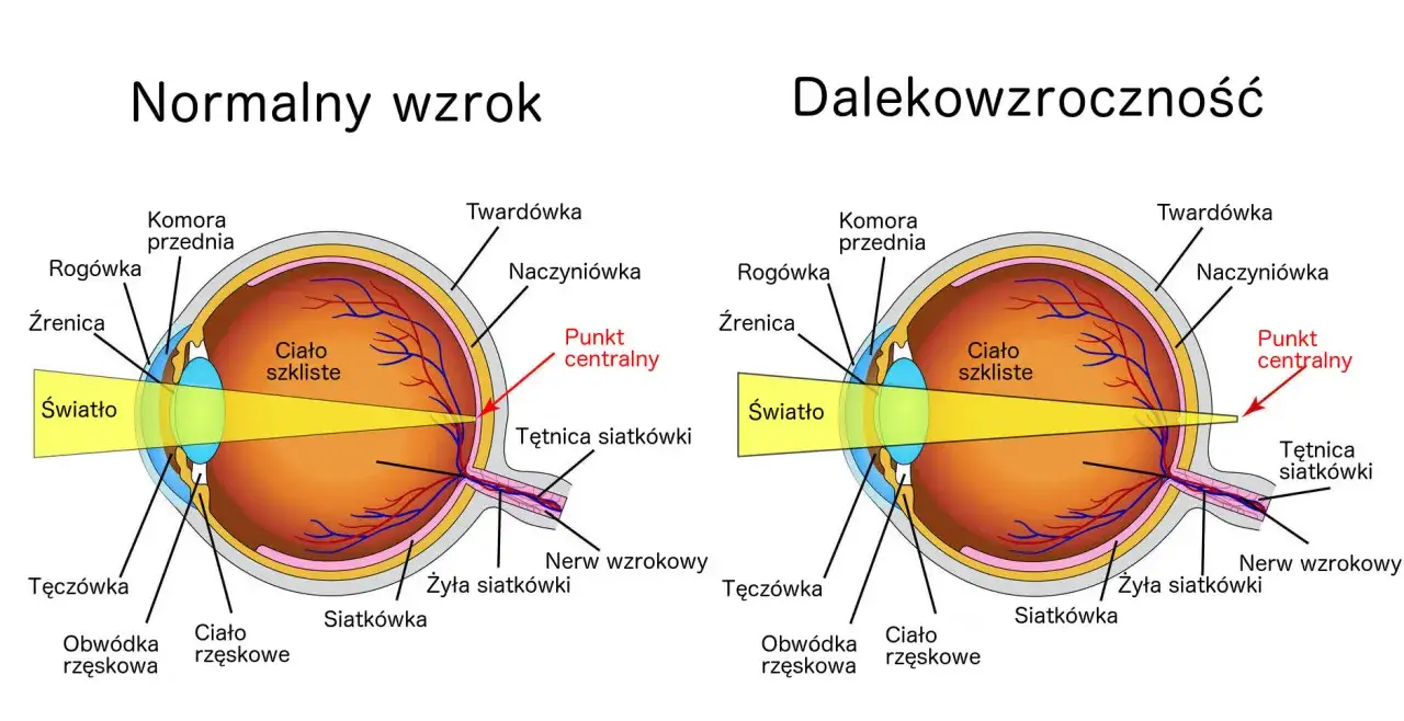 Schemat oka dalekowidza ogniskowanie światła