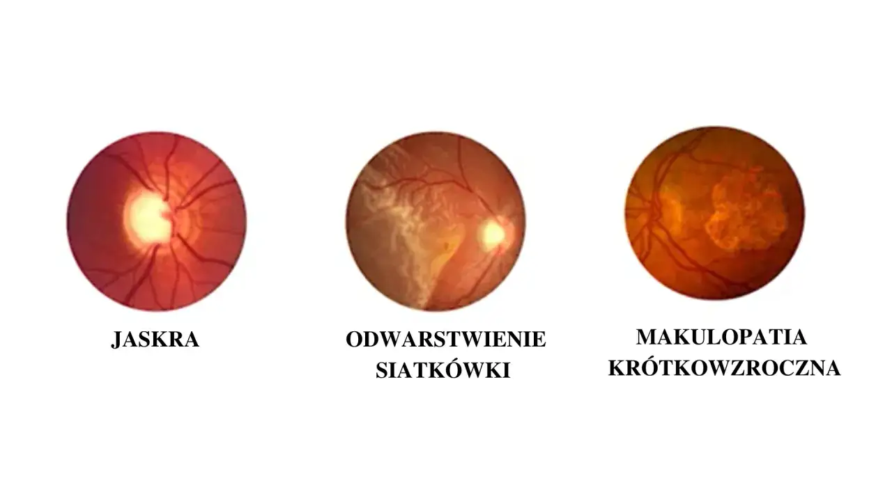 powikłania wysokiej krótkowzroczności siatkówka