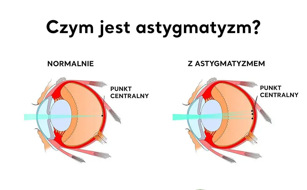 Astygmatyzm schemat oka, nieregularna rogówka