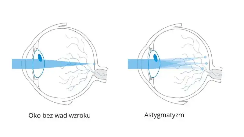 astygmatyzm oko schemat