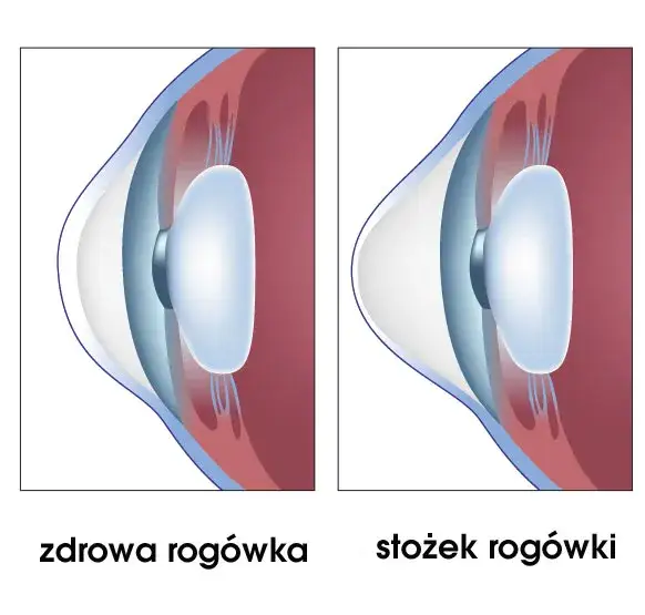 Stożek rogówki porównanie zdrowa rogówka i stożek