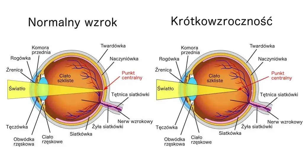 budowa oka krótkowzroczność