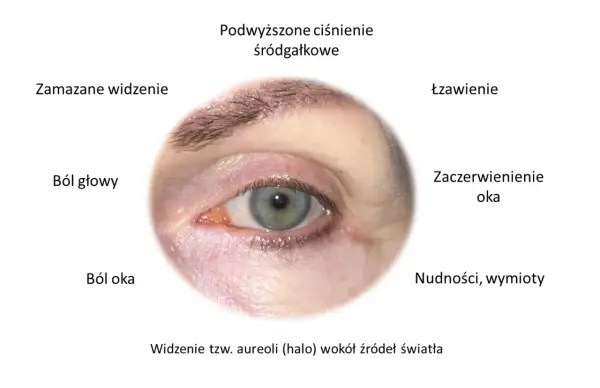 Objawy jaskry: ból oka, łzawienie, zaczerwienienie, zamazane widzenie, bóle głowy, nudności, widzenie aureoli. Czy jaskra jest uleczalna? Wczesne wykrycie kluczowe.