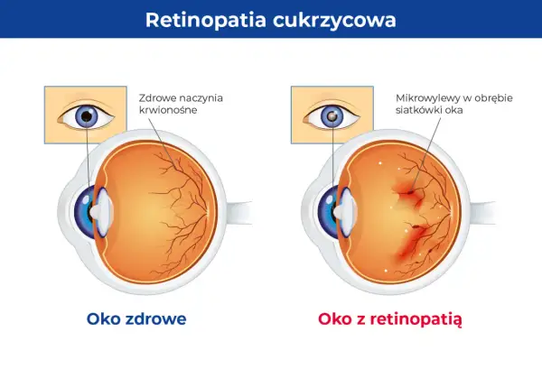 Porównanie oka zdrowego z okiem z retinopatią cukrzycową. W zdrowym oku naczynia krwionośne siatkówki są prawidłowe, w chorym występują mikrowylewy.