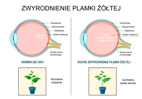 Porównanie zdrowego oka z suchym zwyrodnieniem plamki żółtej, pokazujące utratę ostrości widzenia.