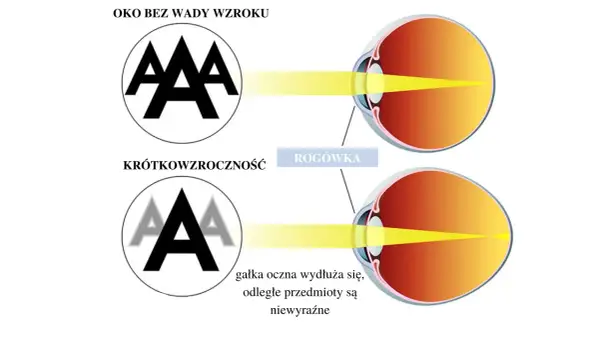 Ilustracja porównuje oko zdrowe z okiem krótkowzrocznym, pokazując różne rodzaje wad wzroku. W krótkowzroczności gałka oczna wydłuża się, powodując niewyraźne widzenie odległych przedmiotów.