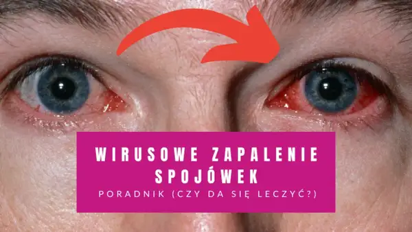 Czerwone, podrażnione oczy z widocznymi naczynkami. Napis informuje o wirusowym zapaleniu spojówek i poradniku leczenia.